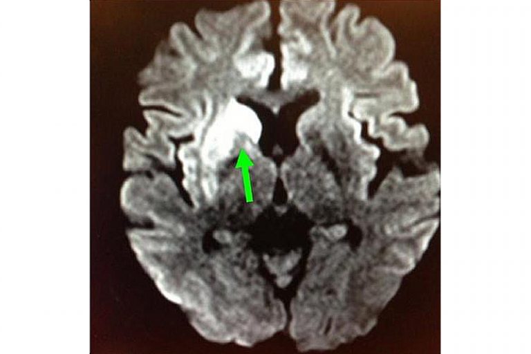 缺血性中風-急救-手術治療-個案-腦血管外科