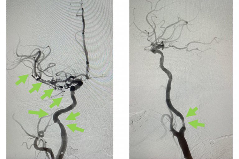 缺血性中風-急救-手術治療-個案-腦血管外科