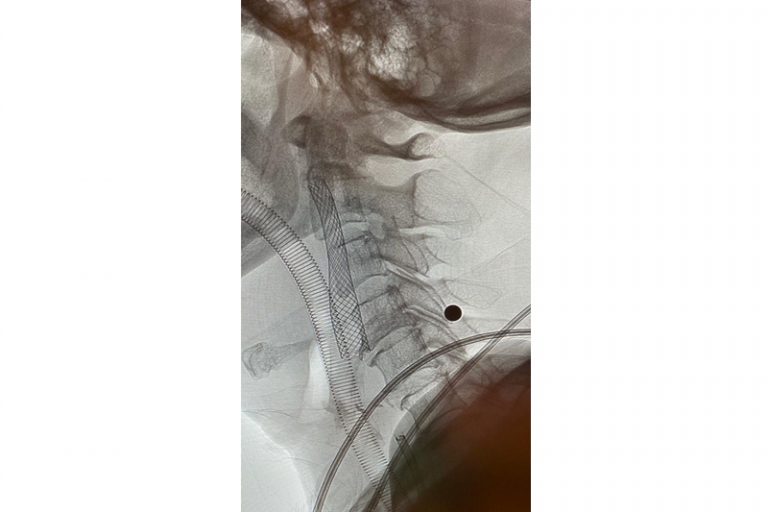 缺血性中風-急救-手術治療-個案-腦血管外科