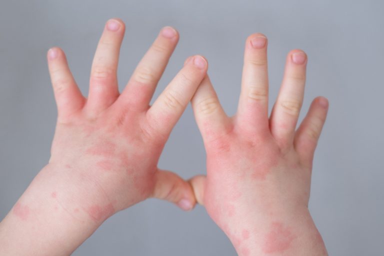 輕微濕疹-濕疹新型治療-口服JAK抑制劑-生物製劑-功效-副作用