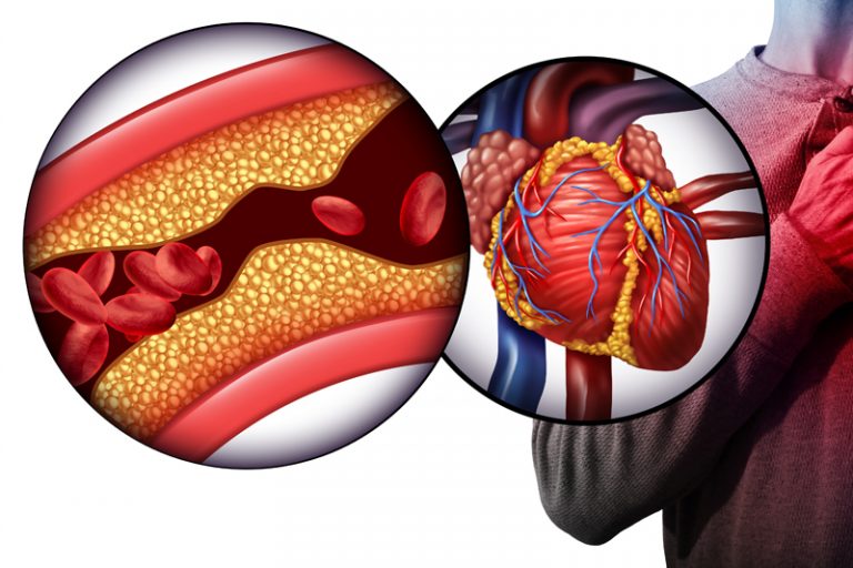 急性心臟病-冠心病-膽固醇