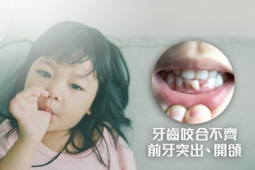 幼童護齒 | 吮手指習慣要戒掉嗎？專家：可能影響頜骨生長的形狀和恆齒排列