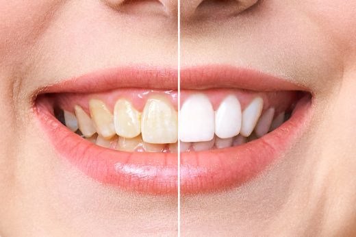 牙齒美白 | 美白牙貼有效嗎？牙醫分享3大漂白牙齒方法：陶瓷貼片、藥劑式美白、家居牙齒美白