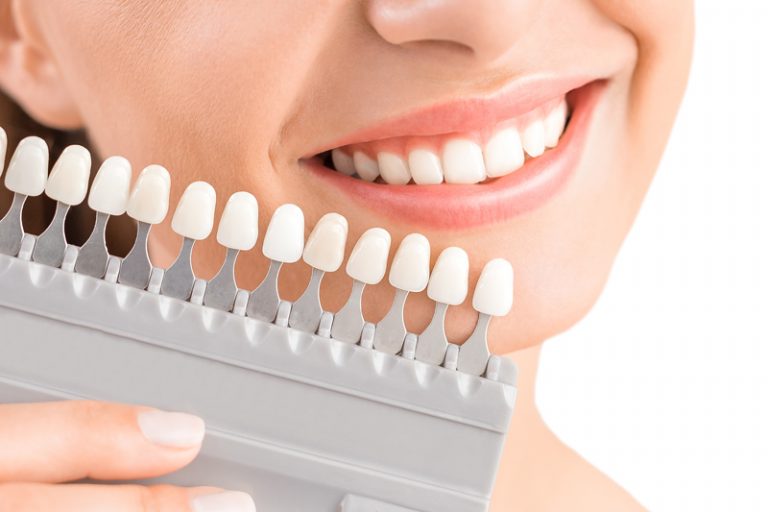 牙齒美白方法-牙貼-漂牙-陶瓷貼片-牙科醫生-趙汗青2