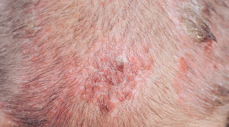 生頭瘡-油膩麻辣食物-中醫拆解頭皮生瘡常見原因-治療方法