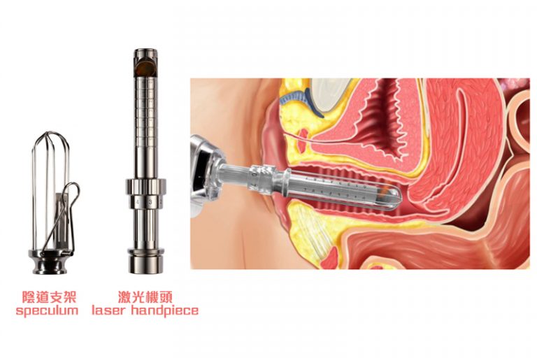 女性陰部回春-激光修陰機-治療原理-鄭曉蔚醫生