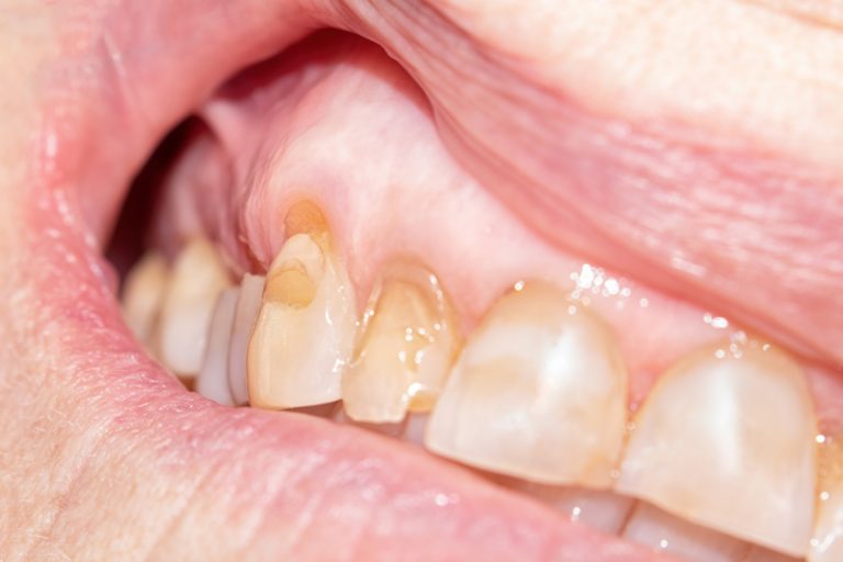 牙齦萎縮-敏感牙齒-成因-治療-港大牙科學院-盧展民醫生