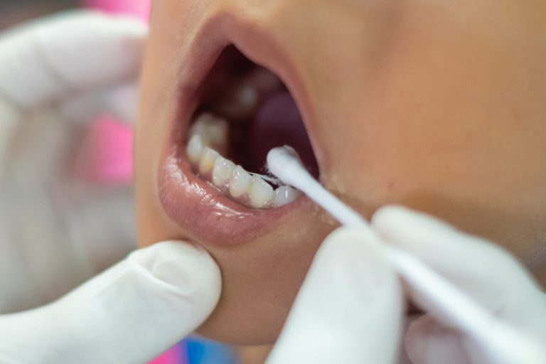 高濃度氟化物塗在牙齒表面-敏感牙齒-成因-治療-港大牙科學院-盧展民醫生