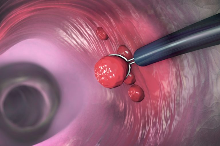 大腸癌篩查計劃-懶人包-大腸癌症狀-檢查-大腸瘜肉癌變-登記資格-登記方法-流程-資助金額