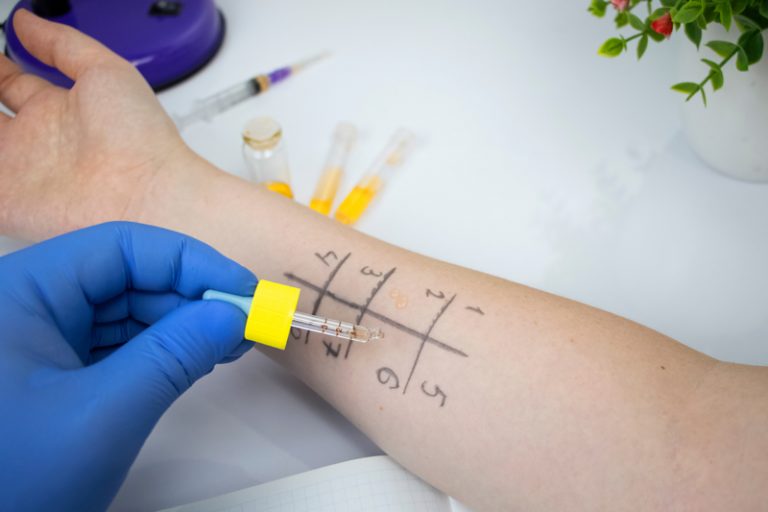 敏感痕癢-誘發食物-組織胺不耐症-症狀-診斷-治療-cancercare.hk