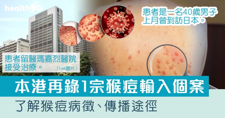 猴痘｜衞生防護中心調查2宗猴痘確診個案｜一文了解猴痘病徵、傳播途徑及治理方法