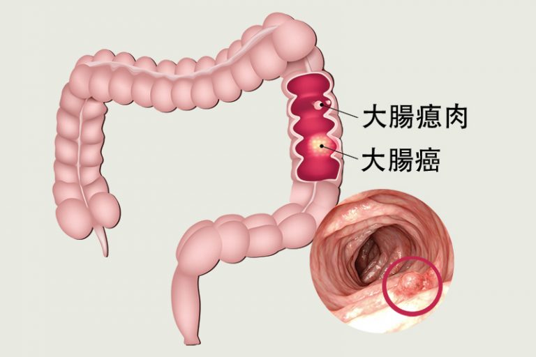 大腸癌篩查-大腸瘜肉癌變無明顯徵兆-外科專科老兆雄醫生