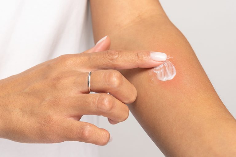 蚊叮蟲咬-細菌性發炎感染-類固醇藥膏-兒科張傑醫生