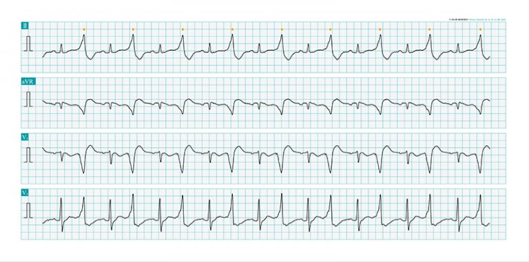 雙聯律Ventricular Bigeminy-甲狀腺亢進-心臟病-心悸-心室性早搏症狀-陳麒尹醫生-心臟科專科