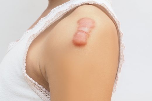 蟹足腫、增生性疤痕會否自行消除？皮膚科醫生詳解蟹足腫成因及治療方法