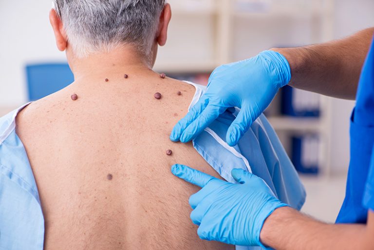 脫墨-脫癦-脫痣-治療方法-脫癦藥水-皮膚科醫生-錯誤使用或留疤痕-激光脫墨-皮膚科專科醫生劉顏銘