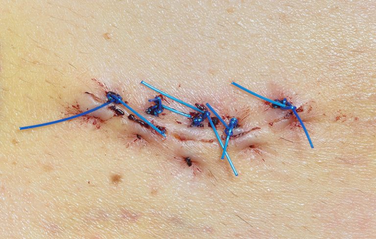 脫墨-脫癦-脫痣-治療方法-脫癦藥水-皮膚科醫生-錯誤使用或留疤痕-激光脫墨-皮膚科專科醫生劉顏銘