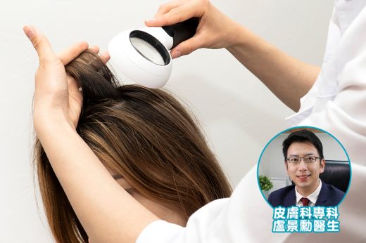 鬼剃頭/斑禿｜未夠30歲就脫髮用「偏方」捽烈酒、塗辣椒有助生髮？醫生：勿亂試！治療方法與免疫系統相關