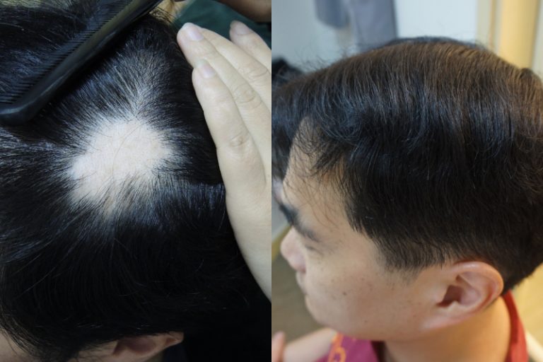 防脫髮-脫髮原因-治療-健髮生髮療程活化毛囊-髮再生