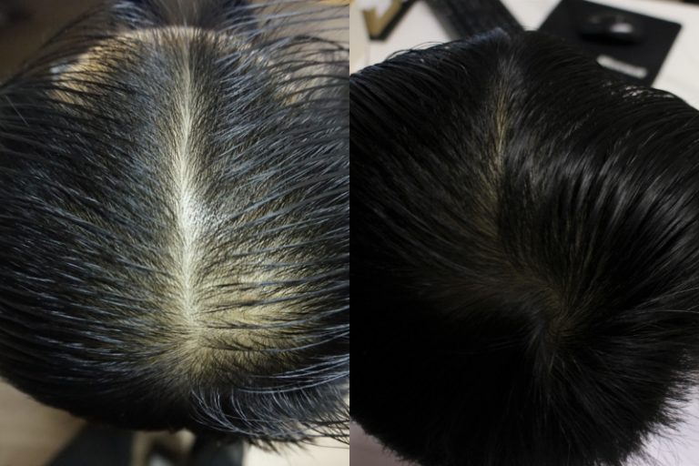 防脫髮-脫髮原因-治療-健髮生髮療程活化毛囊-髮再生