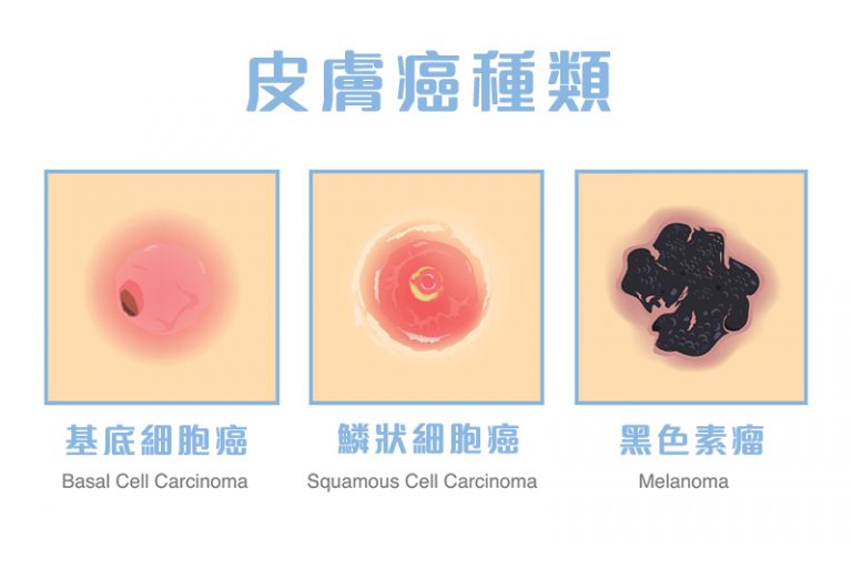 皮膚癌-黑色素瘤-鱗狀細胞癌-基底細胞癌-成因-症狀-種類-治療-預防-皮膚科專科-劉顏銘醫生