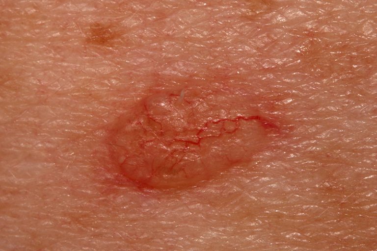 皮膚癌-黑色素瘤-鱗狀細胞癌-基底細胞癌-成因-症狀-種類-治療-預防-皮膚科專科-劉顏銘醫生