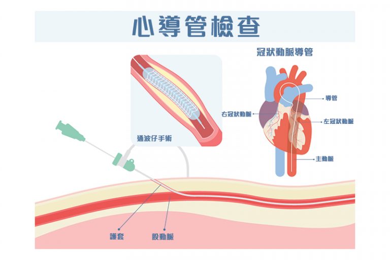 心導管檢查-冠心病治療-成因-症狀-通波仔手術-心臟病發可以毫無先兆