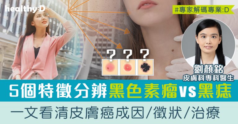 皮膚癌 | 黑色素瘤與良性癦痣有何分別？皮膚科醫生詳解皮膚癌成因、症狀、種類及治療方法