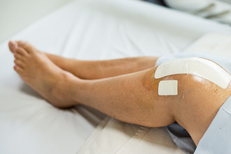 全膝關節置換手術-部分膝關節置換手術優點-分別-手術過程-骨科專科-李崇義醫生