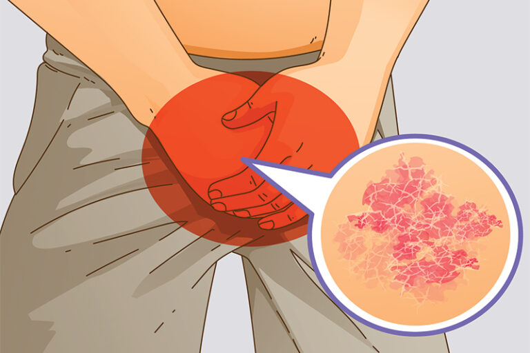 皮膚癬-原因-治療方法-位置-痕癢症狀-濕疹分別-袁靜怡醫生