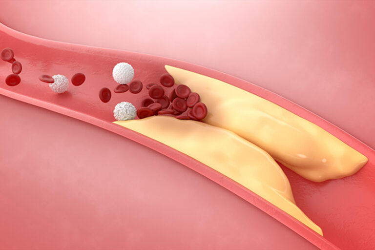 新冠病毒或增心臟病風險-心血管疾病-心臟病發毫無徵兆-陳麒尹醫生