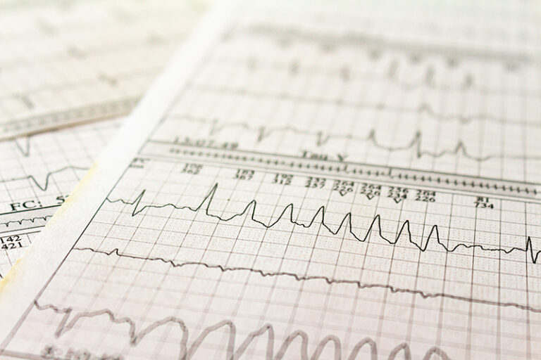 心房顫動治療-脈衝場消融手術-心臟科專科陳杰醫生