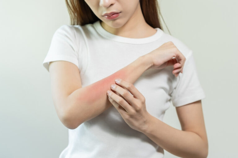 風癩-蕁麻疹-皮膚劇烈痕癢-腫脹發紅-風癩原因-解決-何學工醫生-兒童免疫過敏及傳染病科專科