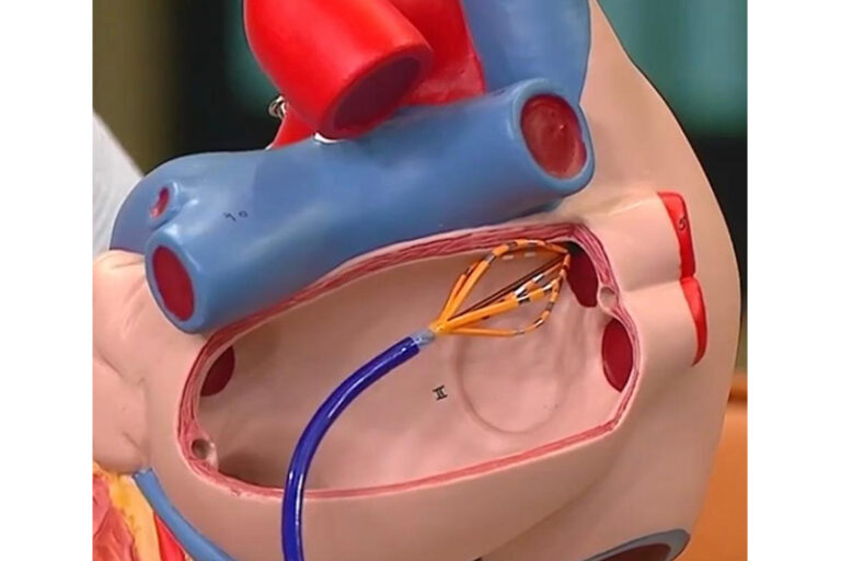 心房顫動治療-脈衝場消融手術-心臟科專科陳杰醫生