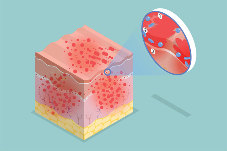 新型濕疹治療-異位性皮膚炎-生物製劑-口服JAK抑制劑-功效-副作用-皮膚科專科-劉顏銘醫生