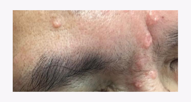 臉上肉粒-扁平疣-汗管瘤-粟粒疹-油脂粒-皮脂腺增生-原因-症狀-治療-皮膚科專科-劉顏銘醫生