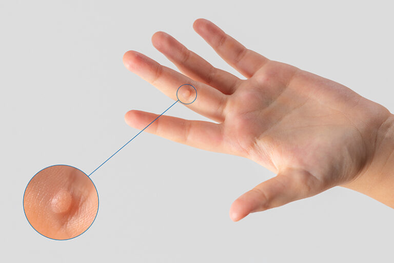 皮膚疣-HPV-原因-治療方法-鄭曉蔚Vivian醫生