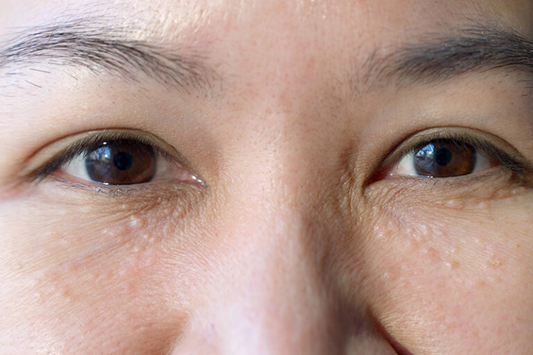 臉上肉粒-扁平疣-汗管瘤-粟粒疹-油脂粒-皮脂腺增生-原因-症狀-治療-皮膚科專科-劉顏銘醫生