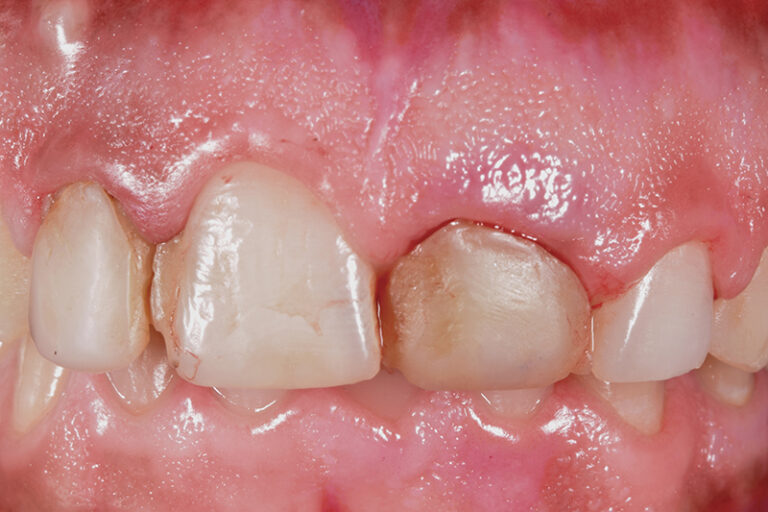 牙周病-刷牙-牙肉萎縮-原因-治療-預防-牙周治療科專科-陳溢謙醫生