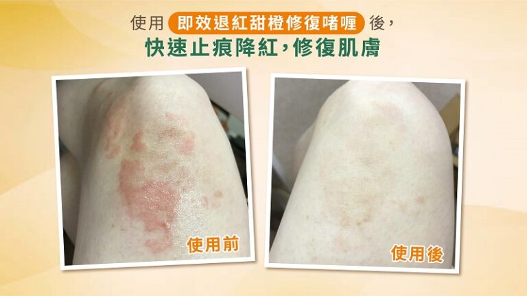 濕疹-皮膚敏感-濕疹藥膏-濕敏