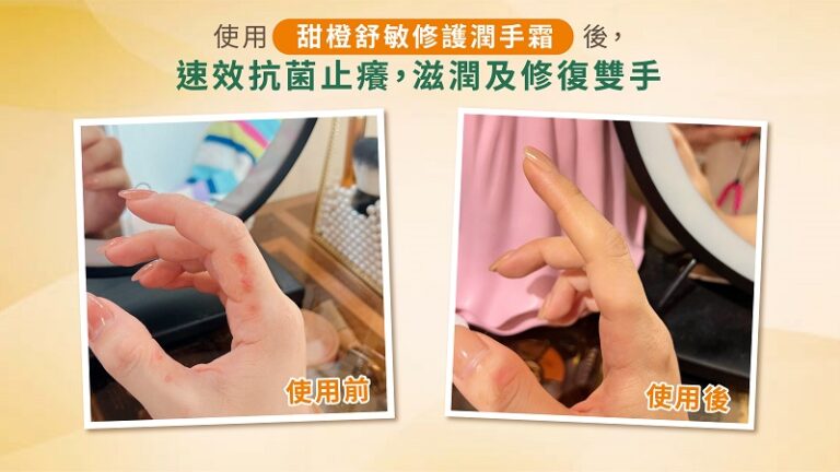 濕疹-皮膚敏感-濕疹藥膏-濕敏