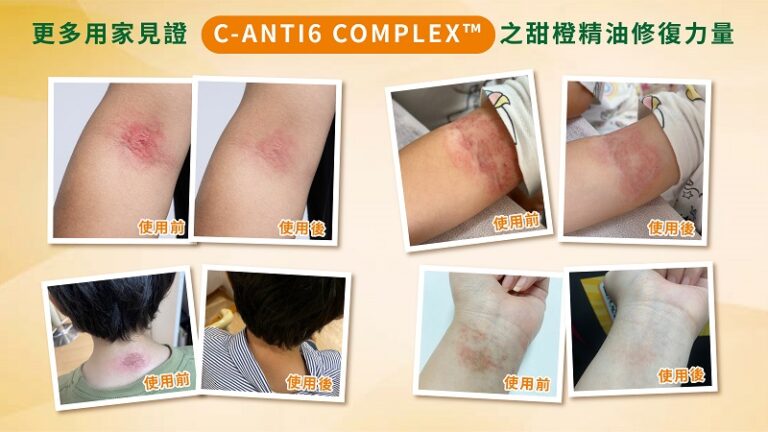 濕疹-皮膚敏感-濕疹藥膏-濕敏