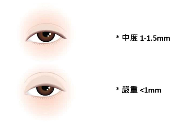 眼瞼下垂-眼簾下垂手術改善-原因-症狀-診斷-治療方法-整形外科梁樹昌醫生