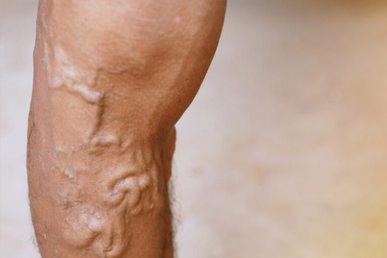 初期青筋症狀不明顯，但若然放任不理，有機會令小腿皮膚變粗、顏色變深，更有機會伴隨皮膚炎等嚴重青筋症狀。