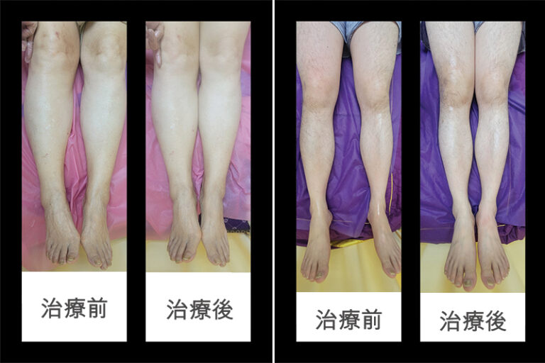 足部治療 -膝痛-腳踝痛-跟膜炎-O型腳-X型腳-成因-中醫正骨-針灸-刺血拔罐療-吳凱琪中醫