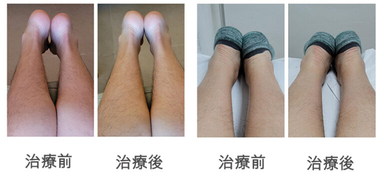 足部治療 -膝痛-腳踝痛-跟膜炎-O型腳-X型腳-成因-中醫正骨-針灸-刺血拔罐療-吳凱琪中醫