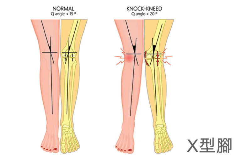 X型腳