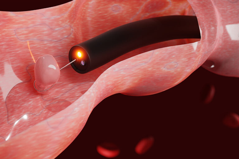 照腸鏡-腸內視鏡檢查-照腸鏡邊間好-檢查中心費用-claim保險-政府政府大腸鏡檢查資助-免費檢查-大腸癌-大腸瘜肉-息肉