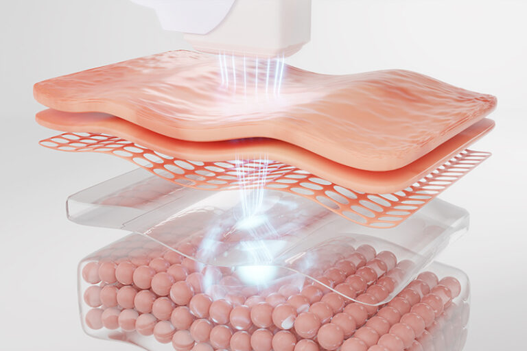 HIFU-射頻-RF-Radiofrequency-功效分別-提升-緊緻-醫學美容-鄭曉蔚醫生