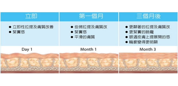 HIFU-射頻-RF-Radiofrequency-功效分別-提升-緊緻-醫學美容-鄭曉蔚醫生